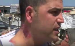 Yanık İzi Tedavisi İçin Gitti, Durumu Daha da Kötüye Gitti