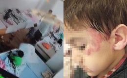 Anaokulunda Dehşet: 4 Yaşındaki Çocuk 3 Yaşındaki Çocuğu 13 Yerinden Isırdı! Doktorlar Aileye “Pitbull Mu Isırdı?” Diye Sordu?