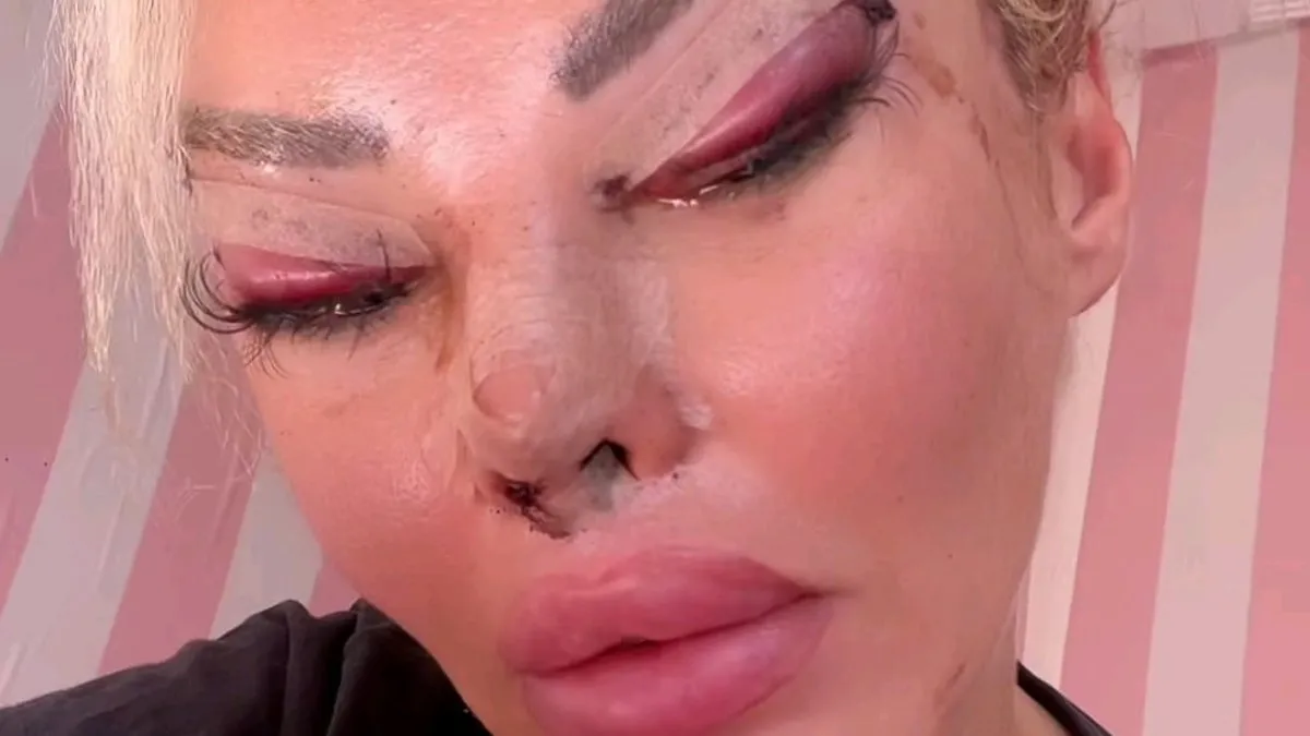 Estetik bağımlısı Tiktok fenomeni Pınar Özkurteller ölümden döndü! Canlı yayınladı…
